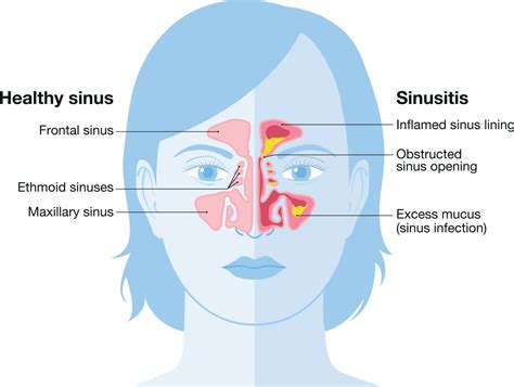 Nasal Congestion and its Impact on Daily Functioning